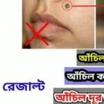 Wart Removing Pen - Image 3