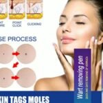 Wart Removing Pen - Image 2